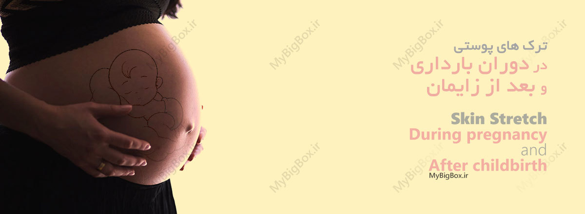 ترک های پوستی بارداری